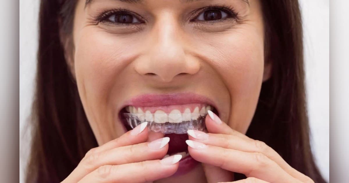 Clear Aligners Offer Discreet Solution for Overbite and Crossbite in Baton Rouge